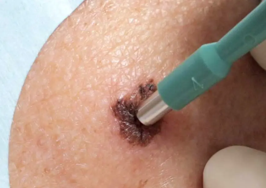 Diagnóstico y tratamiento. Biopsias y criocirugía