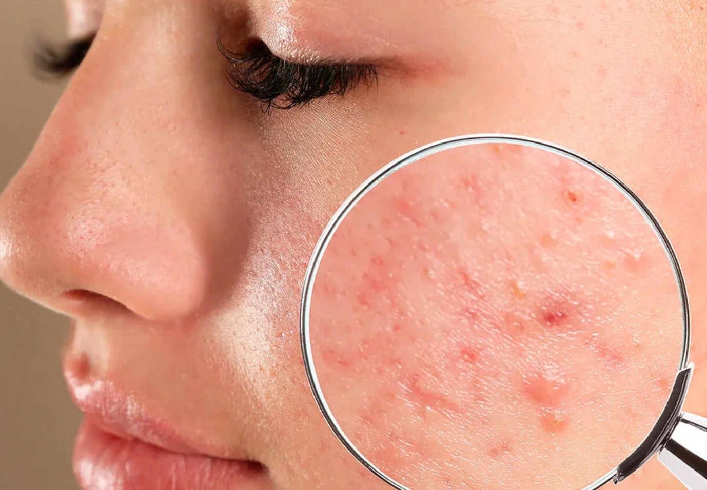 Tratamiento de acné, rosácea y melasma