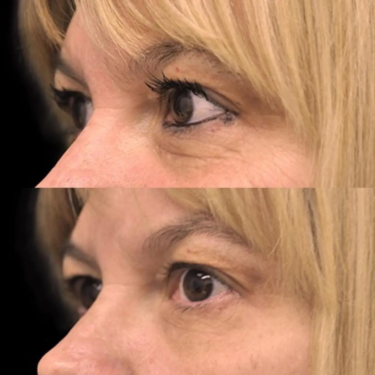 Antes & Después EXILIS