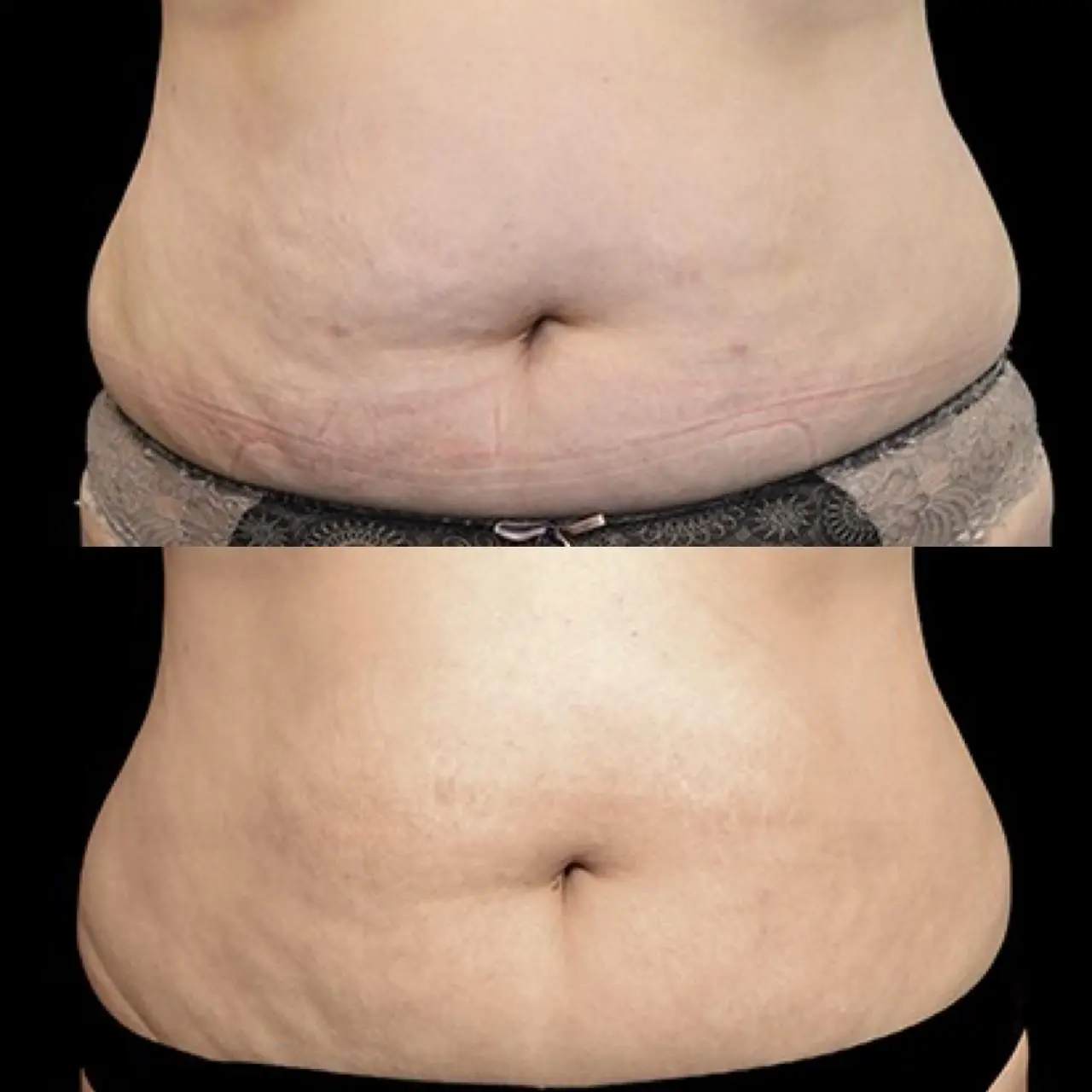 Antes & Después EXILIS