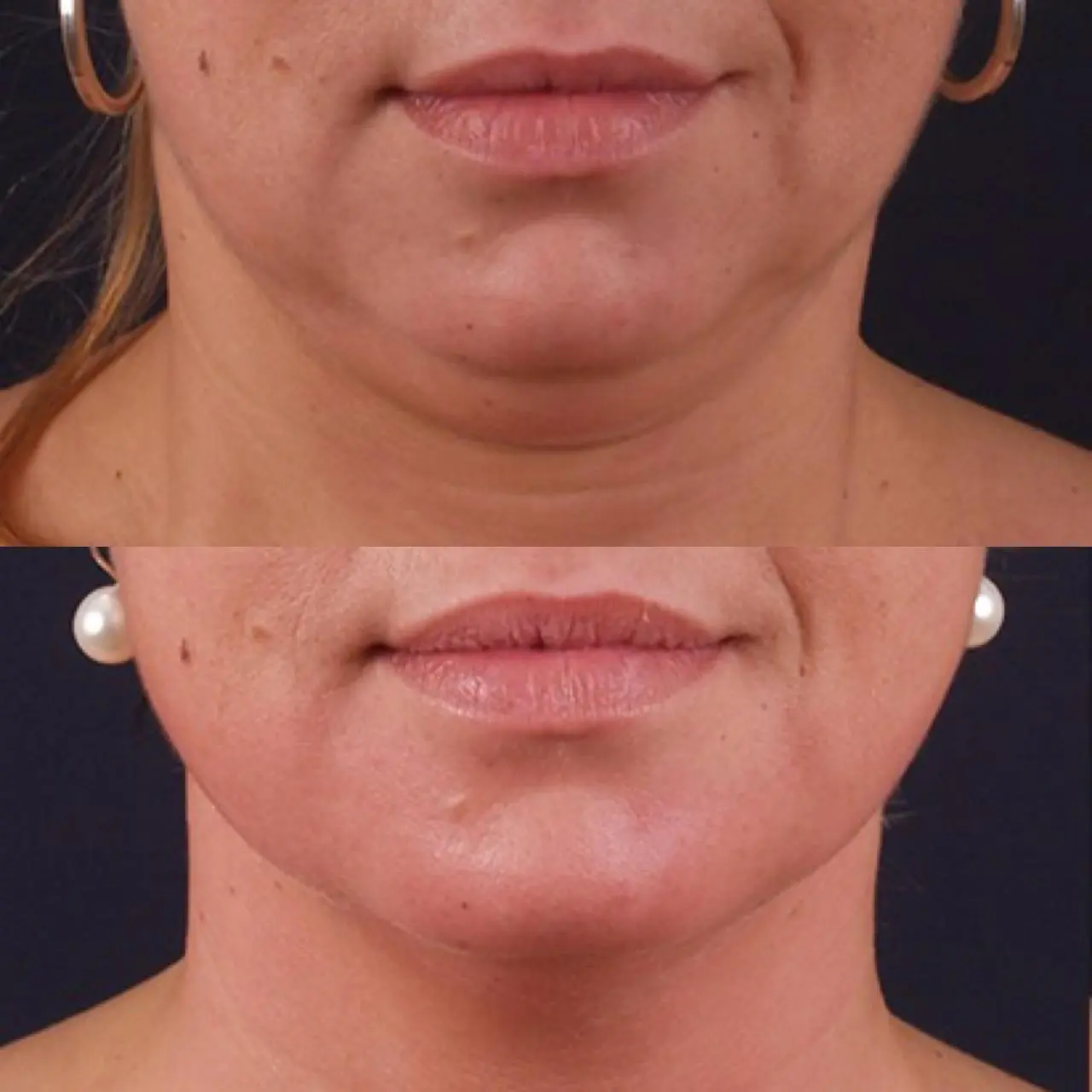 Antes & Después EXILIS